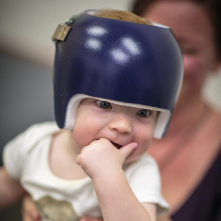 Baby wearing a cranial helmet